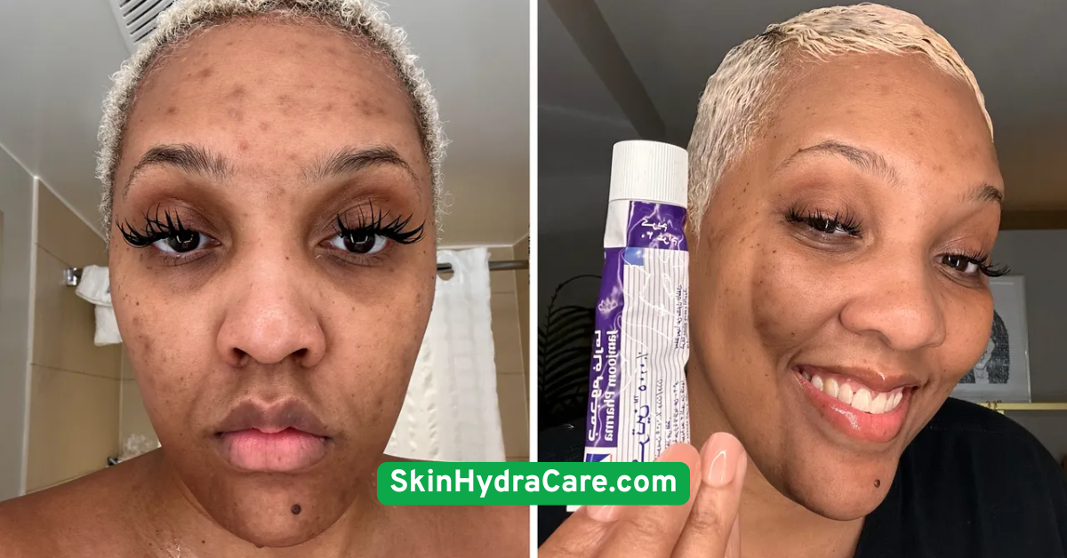 Don’t Overdo Retinoids