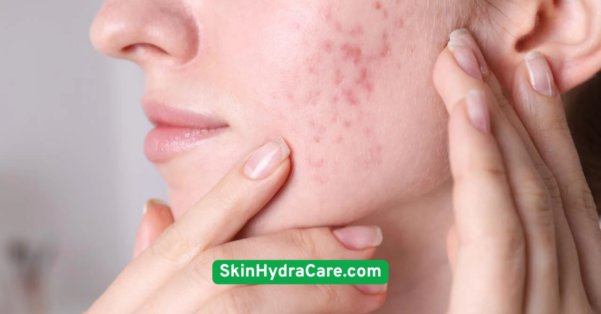 Use a Barrier Repair Cream